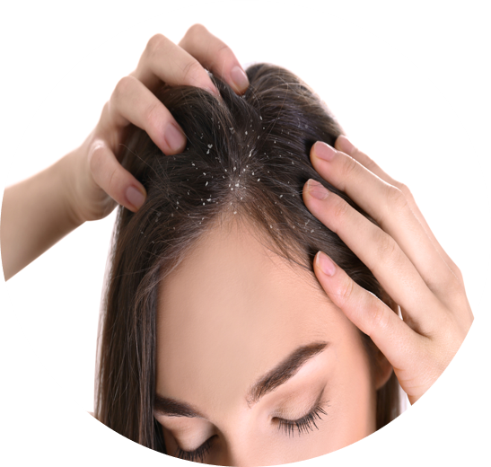 DCURE-clinic-dandruff_treatment