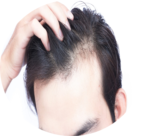 DCURE-clinic-hair_Fall_hair_regrowth_hair_baldness_treatment_best clinic_tirunelveli_PRP_DCURE_hair_Regrowth