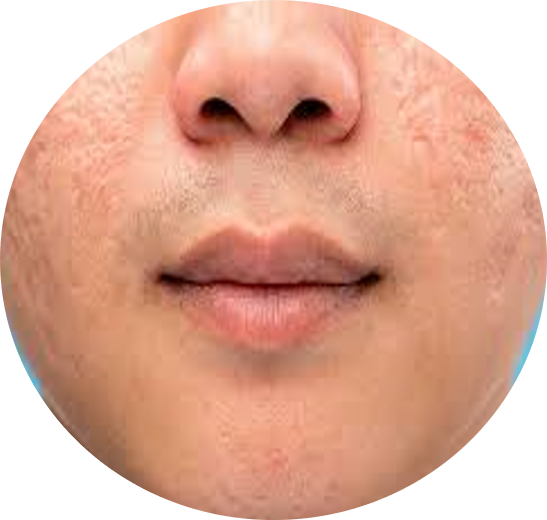 DCURE-clinic-hair_Fall_hair_regrowth_hair_baldness_treatment_skin_acne_treatment_skin_tone_best clinic_tirunelveli_PRP_Full_body_correction__Hydration_skin_peel_skin_tone_open_pore_DCURE_hair_Regrowth