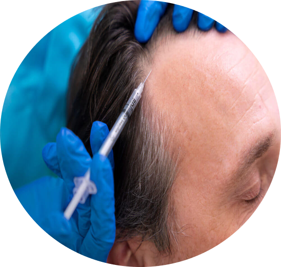 DCURE-clinic-hair_GFC_treatment_best clinic_tirunelveli_PRP_DCURE_hair_Regrowth