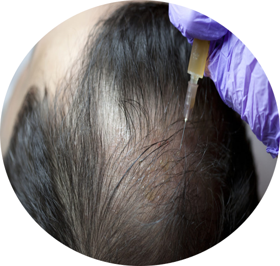 DCURE-clinic-hair_PRP_GFC_treatment_best clinic_tirunelveli_PRP_DCURE_hair_Regrowth