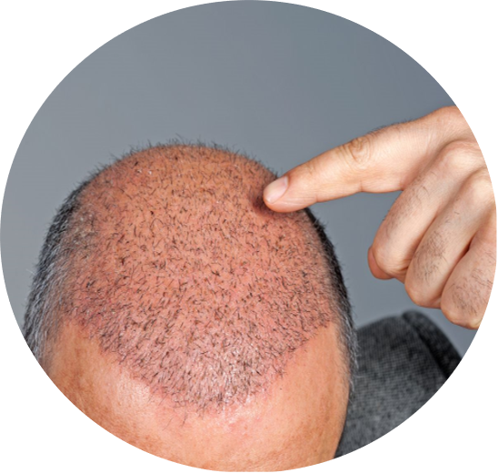 DCURE-clinic-hair_transplant_treatment_best clinic_tirunelveli_