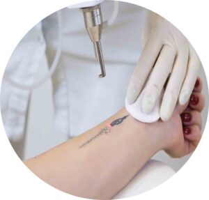 tattoo-removal-tirunelveli-d-cure-clinic_best_no1 clinic_laser treatment tattoo-removal-tirunelveli-d-cure-clinic_best_no1 clinic_laser treatmentlaser_hair_removal_treatment_tattoo_removal_tirunelveli_dcureclinic_D_Cure_clinic_best_laser_treatment_centre_tirunelveli