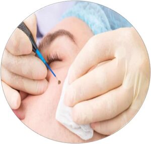 warts Removal_treatment_tirunelveli_D-cure_Clinic warts Removal_treatment_tirunelveli_D-cure_Clinic