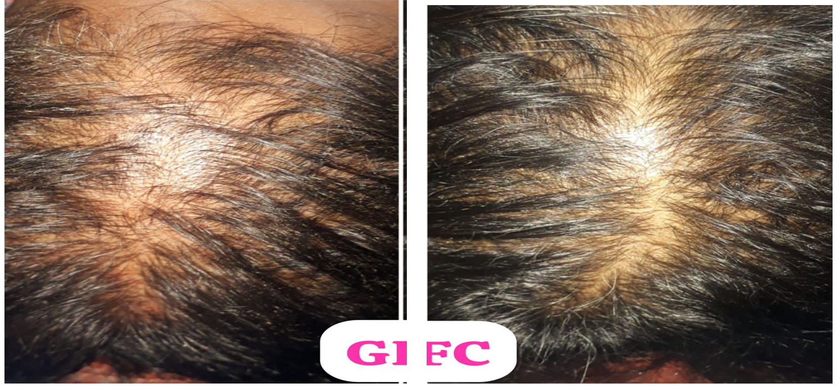 Aesthetics Centre- Tirunelveli- Hair GFC- Hair PRP Best Centre