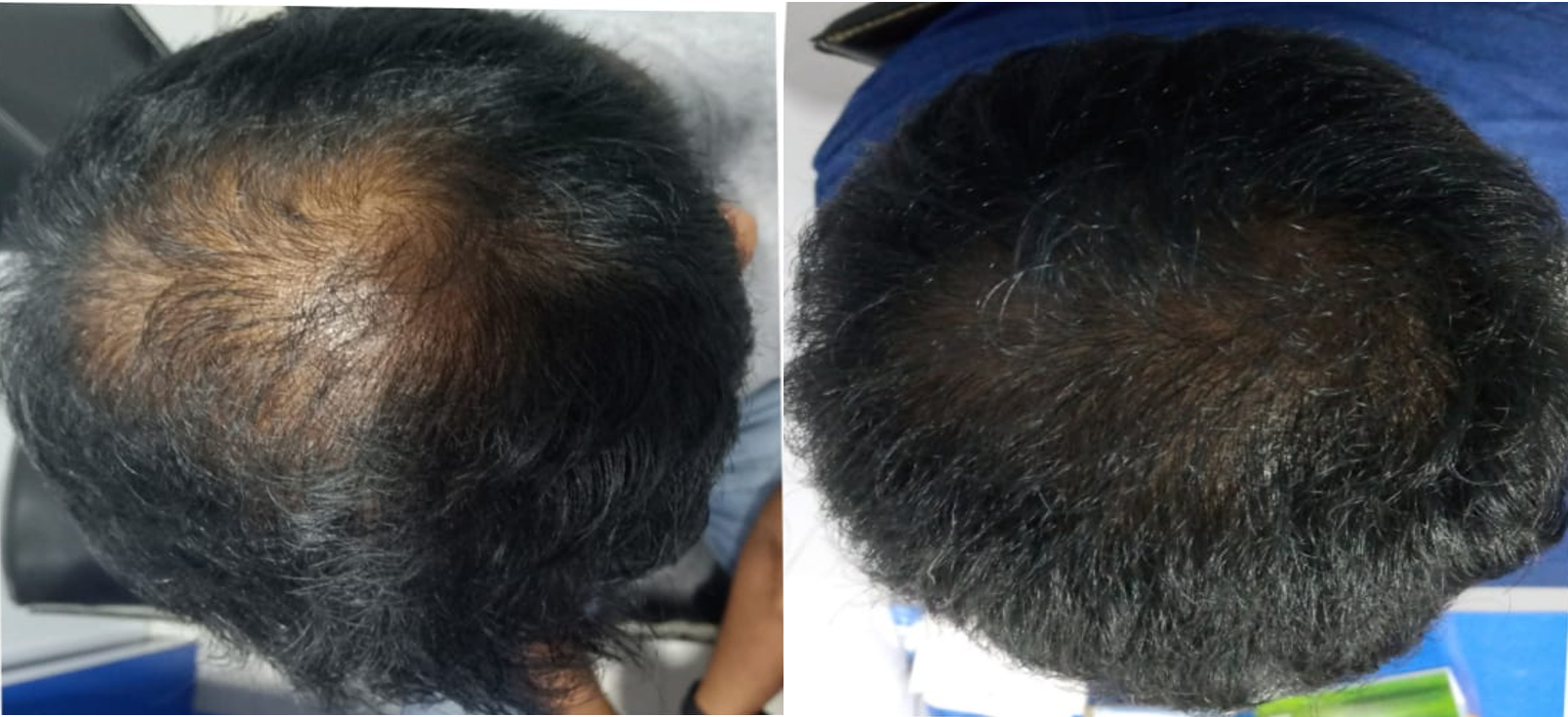 Best skin glow treatment- Aesthetics centre- tirunelveli- GFC- PRP